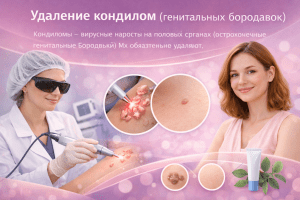 Удаление кондилом