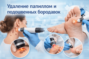 Удаление папиллом и подошвенных бородавок