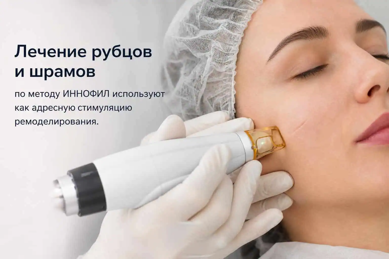 Лечение рубцов и шрамов по методу ИННОФИЛ с видимым результатом Лечение рубцов и шрамов по методу ИННОФИЛ с видимым результатом