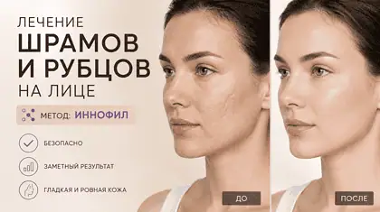 Лечение шрамов и рубцов на лице — современные методы восстановления кожи